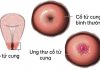 Biểu hiện của ung thư cổ tử cung