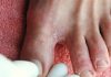 Nước Ăn Chân Và Các Bài Thuốc Chữa Cực Hiệu Quả Trong Mùa Mưa