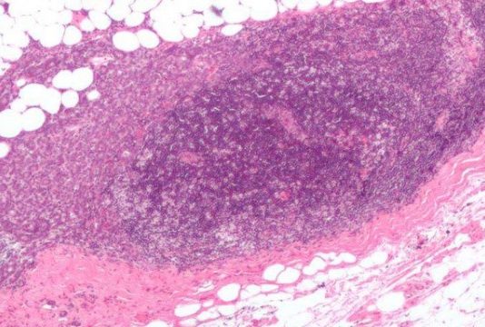 ĐÃ TÌM THẤY “THỦ PHẠM” KHÁNG LẠI THUỐC ĐIỀU TRỊ UNG THƯ VÚ