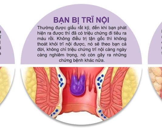 Những điều quan trọng cần biết về bệnh trĩ vào mùa nóng