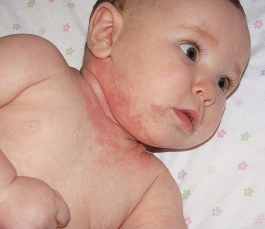 Những sai lầm Mẹ cần tránh khi chống hăm cho bé