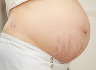 Nguyên nhân gây nên rạn da ở bà bầu và cách khắc phục