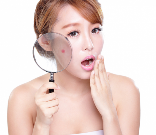 Những điều cần tránh khi chăm sóc da mụn Người ta thường có xu hướng tìm các cách trị vết thâm mụn mà không hề chú ý đến các thói quen hằng ngày khi bị mụn. Và bạn có biết, chính những thói quen hằng ngày tưởng như vô hại kia đôi khi lại chính là nguyên nhân khiến bạn trị mãi mà các vết mụn thâm vẫn không hết. Do đó, bên cạnh việc tìm hiểu cách xóa sổ các vết thâm đáng ghét, bạn cũng nên từ bỏ ngay các thói quen sau đây: 1. Nặn mụn bằng tay Đã từ rất lâu, các nhà khoa học đã chứng minh rằng dưới móng tay chúng ta là cả rừng vi khuẩn. Dù bạn có chà xát hay cọ rửa kỹ đến đâu thì chúng vẫn sẽ tiếp tục phát triển theo từng giây. Chính vì thế, việc táy máy dùng tay để nặn mụn sẽ vô tình khiến vi khuẩn khuếch tán rộng hơn trên da. Từ đó, mụn sẽ bùng phát trên diện rộng và gây nguy hiểm cho bạn so với ban đầu rất nhiều lần. Ngoài ra, không phải tất cả các loại mụn đều có thể nặn được và luôn an toàn khi nặn bằng dụng cụ y khoa. Nếu không biết cách vệ sinh sạch sẽ dụng cụ trước khi sử dụng hoặc không biết cách nặn mụn như thế nào cho đúng thì tại thời điểm ấy, bạn đã vô tình phá vỡ nang lông và mủ sẽ bắn sang các vùng da lân cận làm cho mụn ngày càng xuất hiện nhiều hơn. Do đó, để tránh nguy cơ mụn lại phát triển nhiều trên da mặt, bạn nên hạn chế nặn mụn bằng tay và phải làm sạch dụng cụ trước và sau khi nặn mụn. Luôn vệ sinh dụng cụ nặn mụn trước và sau khi dùng 2. Rửa mặt quá nhiều lần Phần lớn chúng ta xem việc rửa mặt nhiều lần trong ngày là một cách trị thâm mụn nhanh hiệu quả bởi vì càng rửa mặt nhiều thì càng rửa trôi được nhiều bụi bẩn, da mặt sẽ lại càng sạch hơn. Thế nhưng, điều này lại chính là nguyên nhân khiến cho mụn bùng phát nhanh hơn trên và ngày càng khó trị triệt để. Nguyên nhân là vì rửa mặt nhiều lần, nhất là thường xuyên chà xát mạnh khi rửa sẽ khiến lớp da ngoài cùng bị tổn thương, từ đó làm tăng khả năng bị kích ứng. Không những thế, việc rửa mặt quá thường xuyên sẽ dẫn đến kích thích các tuyến nhờn hoạt động mạnh hơn bình thường để bù đắp lại lượng dầu vừa bị mất. Quá trình này tái diễn liên tục sẽ khiến các lỗ chân lông bị bít và nguy cơ xuất hiện mụn cũng nhiều hơn. Và dĩ nhiên, khi ấy vết thâm là điều khó tránh khỏi. Để không phải gặp tình trạng này, chúng ta chỉ nên rửa mặt từ 2 lần/ngày và 3 lần/ngày với thời tiết nắng nóng. Trong quá trình rửa mặt, chúng ta chỉ cần massage nhẹ nhàng và có thể sử dụng sữa rửa mặt phù hợp để loại bỏ bụi bẩn. Tuyệt không nên “kỳ cọ” quá kỹ vì sẽ khiến da dễ bị kích thích, đỏ lên và bị tổn thương. 3.Chỉ dùng các loại mặt nạ thiên nhiên Các sản phẩm có nguồn gốc rõ ràng và có thành phần từ tự nhiên, đặc biệt là các loại mặt nạ luôn được chào đón một cách nồng nhiệt bởi sản phẩm sẽ ít gây ra tác dụng phụ hay thậm chí hoàn toàn không có. Thế nhưng, những loại mặt nạ từ thiên nhiên chỉ thực sự có tác dụng cho các vết thâm mới và chỉ có tác dụng làm sáng da là chính. Với vết thâm mụn cũ, bạn cần phải có những loại sản phẩm chuyên dụng với thành phần hóa học được kết hợp theo một tỉ lệ thích hợp nhất thì mới có thể phát huy tối đa hiệu quả cũng như giảm tối thiểu khả năng bị dị ứng với thuốc. Để tìm được một sản phẩm chuyên dụng như vậy trên thị trường hiện nay sẽ là một thách thức lớn cho chị em bởi tình trạng hàng giả, hàng nhái đang ngày càng lan rộng và không có dấu hiệu dừng lại. Với sự kiểm định nghiêm ngặt của các tổ chức châu Âu trên 250 đối tượng khác nhau và tất cả các kết quả nhận được đều chứng minh sự an toàn lên đến 100%. Với hoạt chất MPS giúp làm mờ thâm, Allium Cepa giúp làm kháng viêm, Pionin giúp ngăn mụn tái phát và Vitamin B3 giúp làm sáng da, sản phẩm sẽ giúp bạn cải thiện tình trạng mụn thâm chỉ sau 4 tuần sử dụng. Với sự kiểm định nghiêm ngặt của các tổ chức châu Âu, Hiruscar Post Acne là sản phẩm đáng tin cậy để bạn đẩy lùi vết thâm mụn Để cải thiện những tổn thương sau mụn, bạn không chỉ phải có sự kiên trì mà còn phải tìm hiểu cách trị vết thâm mụn khoa học. Hãy bỏ ngay các thói quen có hại trên đây trong quá trình chăm sóc các tổn thương do mụn, bạn sẽ bất ngờ vì hiệu quả mà nó đem lại đấy! Tham khảo thêm các bài viết Kem trị thâm hiruscar Kem liền sẹo hiruscar Gel trị thâm mụn Kem tri tham mun hieu qua Kem trị thâm Kem trị thâm mụn hiệu quả