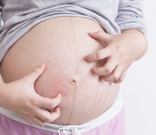 Có nên sử dụng kem chống rạn da khi đang mang thai