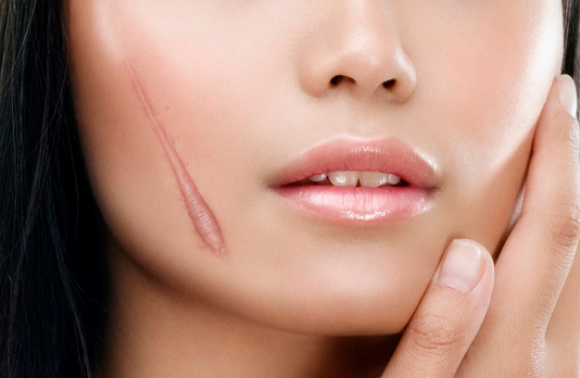 HIRUSCAR- SẢN PHẨM TRỊ SẸO HIỆU QUẢ TỪ THỤY SĨ