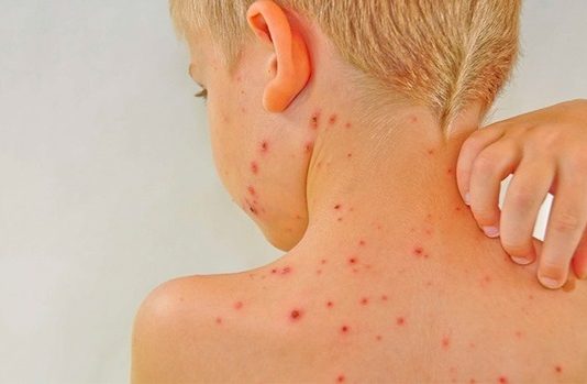 Trị ngứa do côn trùng cắn an toàn cho bé thuốc bôi côn trùng cắn cho bé