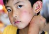 thuốc trị muỗi đốt cho bé