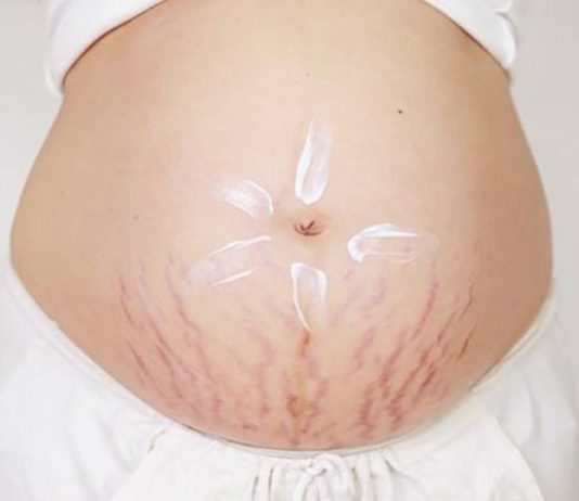 ngăn ngừa rạn da khi mang thai