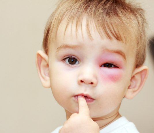 thuốc bôi côn trùng cắn cho bé