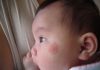 thuốc trị muỗi đốt cho bé