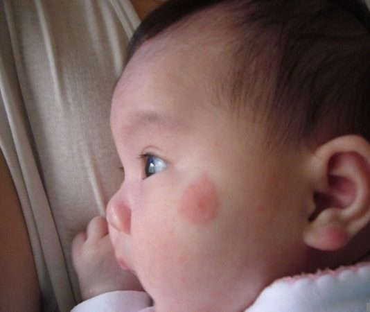 thuốc trị muỗi đốt cho bé