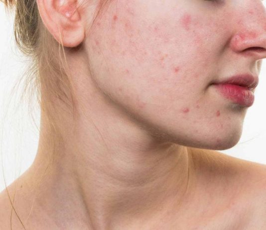 Lời khuyên của Bác sĩ dành cho những mẹ gặp phải tình trạng mụn khi mang thai