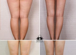 Chăm sóc đúng cách sau khi giảm mỡ bắp chân bằng sóng siêu âm