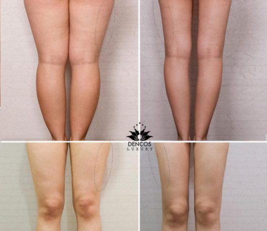 Chăm sóc đúng cách sau khi giảm mỡ bắp chân bằng sóng siêu âm