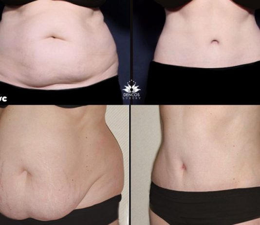 Tuyệt chiêu giảm mỡ bụng dưới tận gốc cho cả nam và nữ